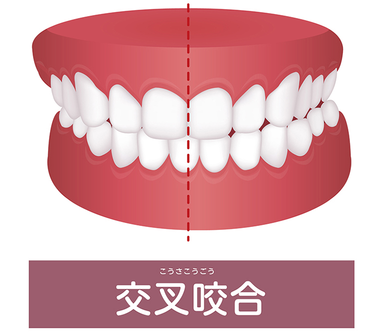 噛み合わせが悪い（交叉咬合）